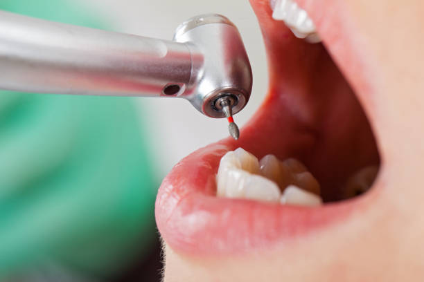 Best Dental Abscess Treatment in Orland, CA